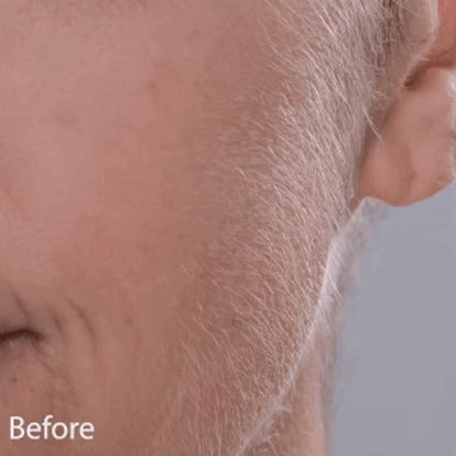 Sonic Dermaplaning